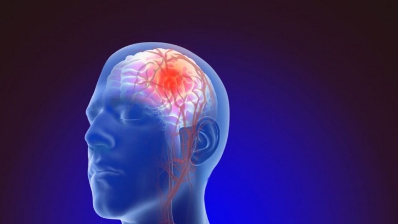 Зачестяват случаите на мозъчни инсулти сред младите хора Свързано ли
