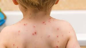 Епидемия от морбили избухна в Северен Лондон Над 60 деца